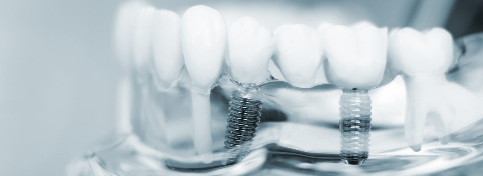 Advanced Dental Care of Towson | Implant Restorations, Cosmetic Dentistry and Dentures