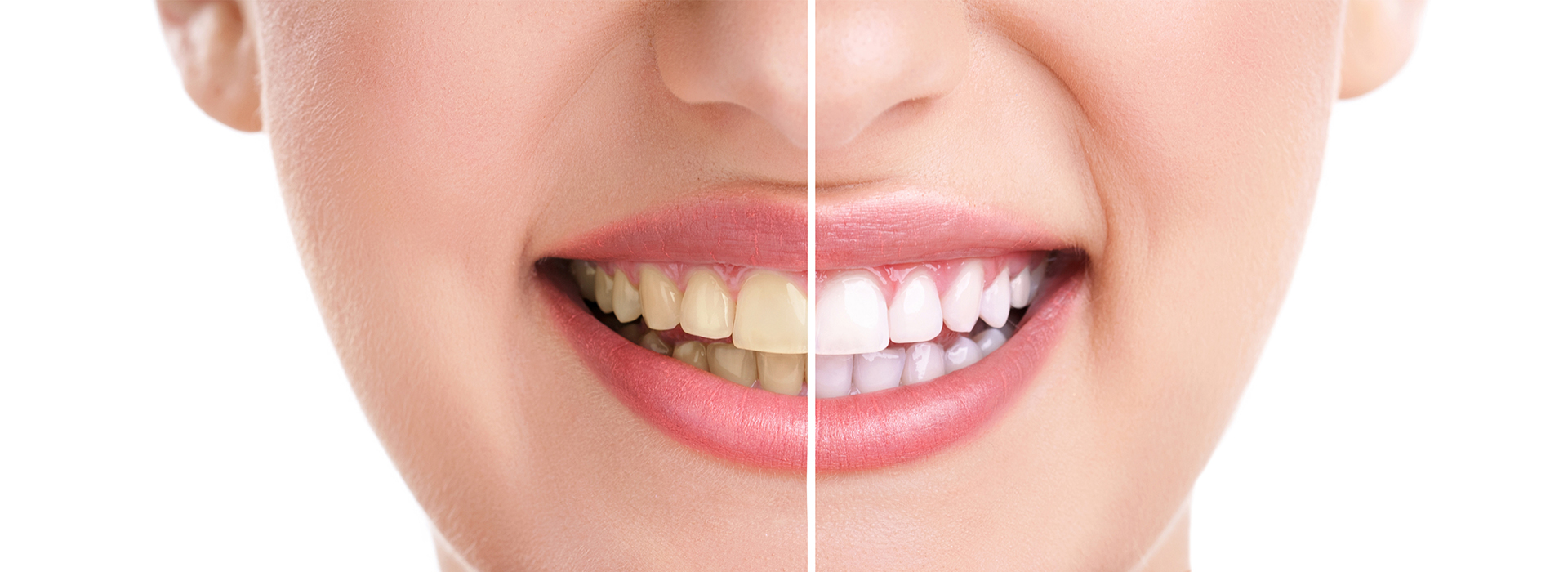 Advanced Dental Care of Towson | Dentures, Preventative Program and Veneers